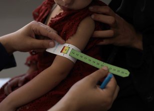 A measuring band for malnutrition around a child's arm. The band is on yellow, moving towards red.